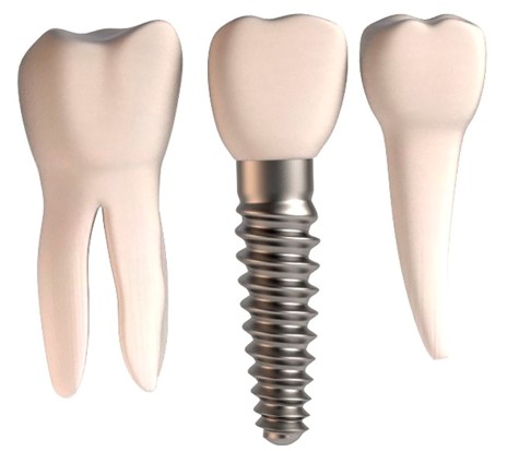 Dental Implants