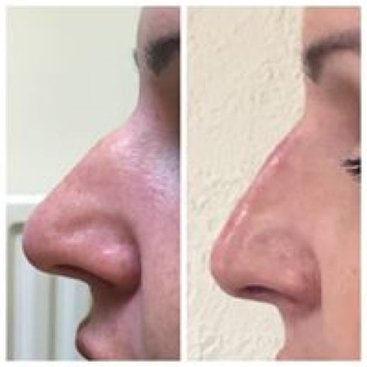 NON SURGICAL RHINOPLASTY